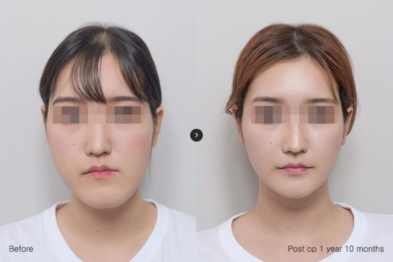 รพ.eu ผ่าตัดขากรรไกร, วีไลน์, ใบหน้าไม่เท่ากัน 01