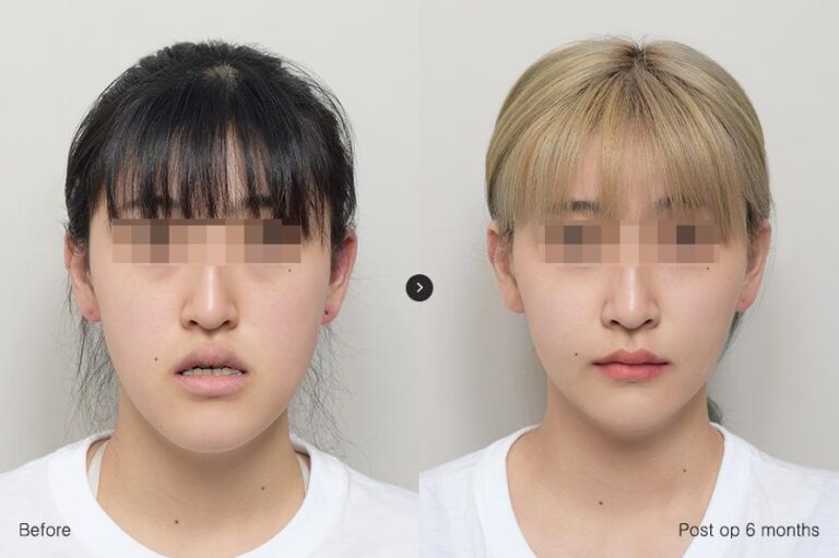 รพ.eu ผ่าตัดขากรรไกร,มินิวีไลน์ 01