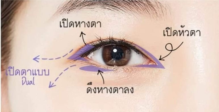 รีวิวศัลยกรรมเกาหลีจริง แนะนำเคสรีวิวเสริมจมูกและตาหวาน โดย Queen Surgery