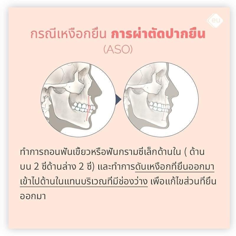 การผ่าตัด ASO