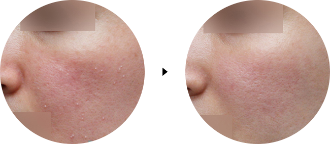dermatology causeofacne bfaf 01 (1)