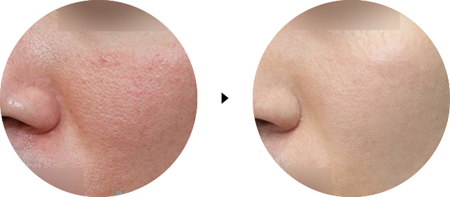 dermatology causeofacne bfaf 03 (1)