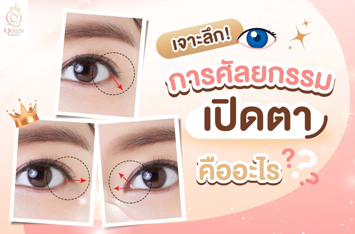 ศัลยกรรมเปิดตา คืออะไร ทำไมควรทำ จำเป็นหรือไม่ เหมาะกับใคร การศัลยกรรมเปิดตาคืออะไร?