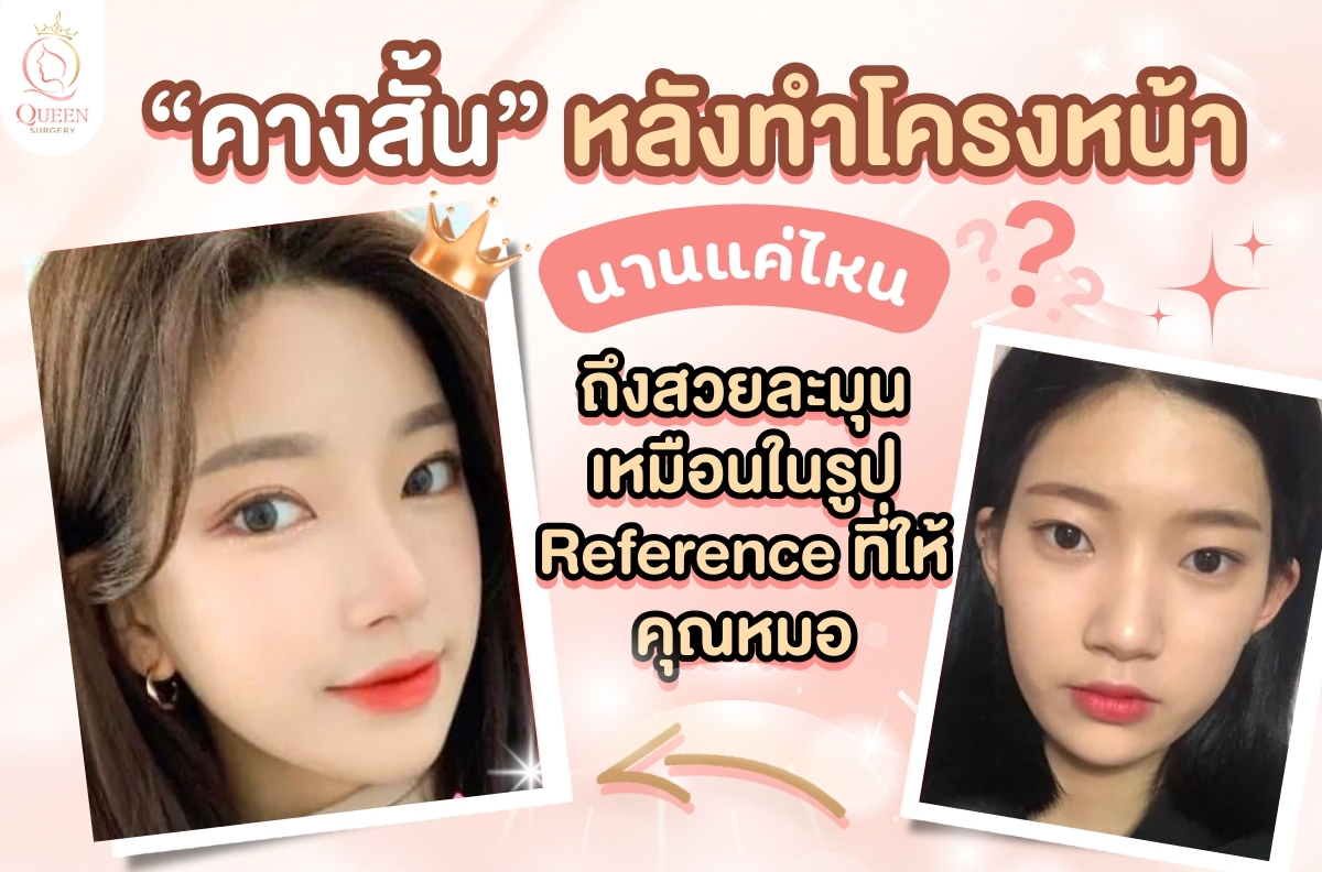 ทำศัลยกรรมโครงหน้าสามจุด คางสั้นหลังทำโครงหน้าสามจุด นานแค่ไหนถึงสวยละมุนเหมือนรูป Reference ที่ให้คุณหมอ