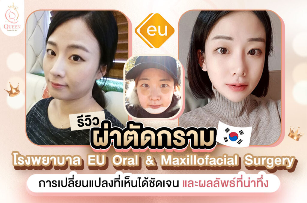 ผ่าตัดกราม ที่โรงพยาบาล EU ศัลยกรรมเกาหลี