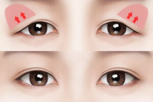 วิธีแก้หนังตาตก วิธีแก้หนังตาตก