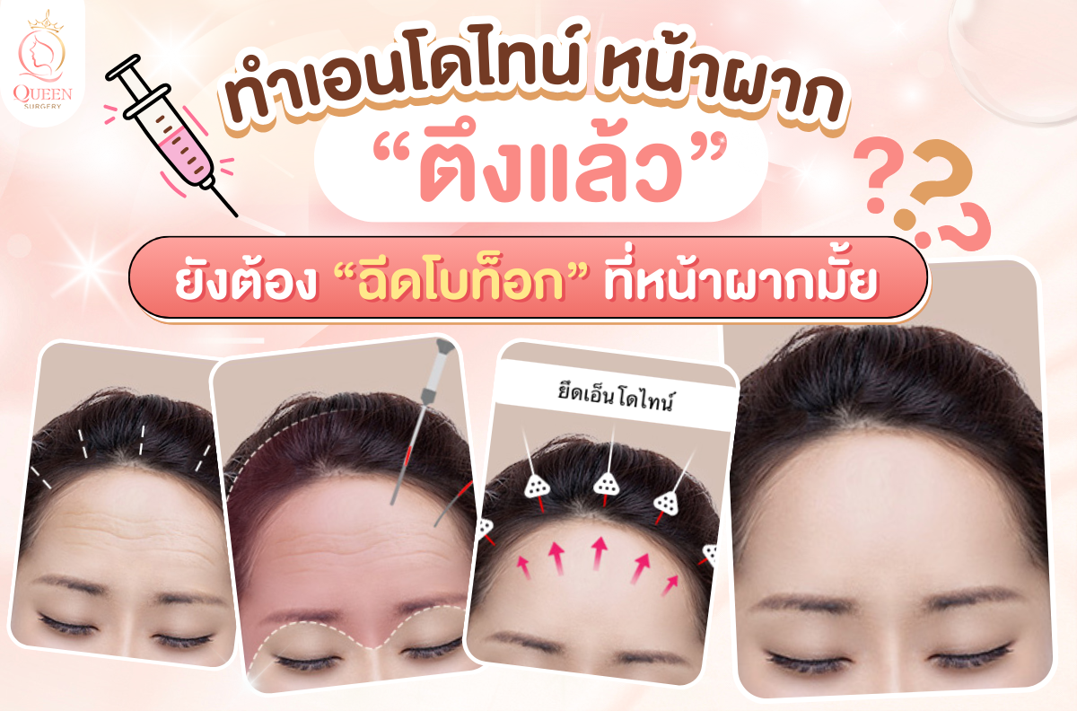 ทำเอ็นโดไทน์ หน้าผากตึง