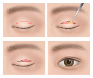 CK tc06120000140 ตาสองชั้นแบบเกาหลี