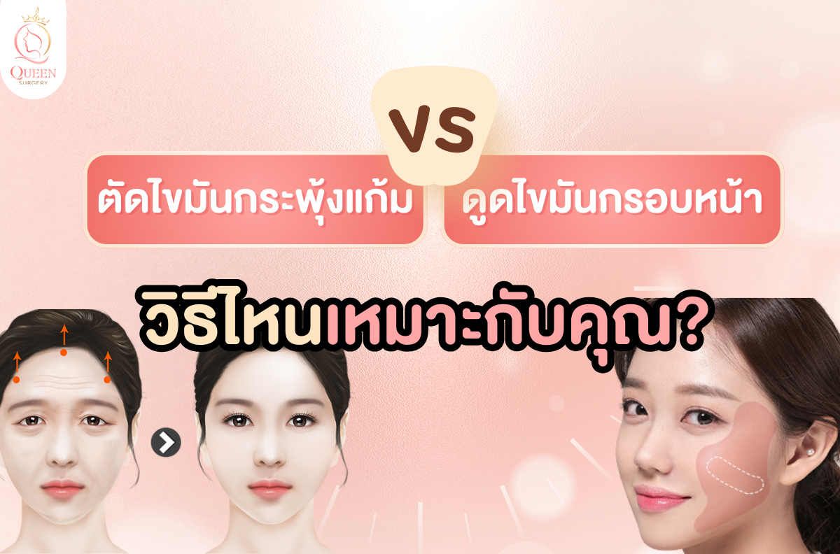 ตัดไขมันกระพุ้งแก้ม ดูดไขมันกรอบหน้า