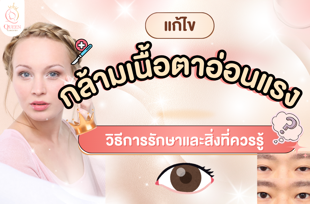 กล้ามเนื้อตาอ่อนแรง