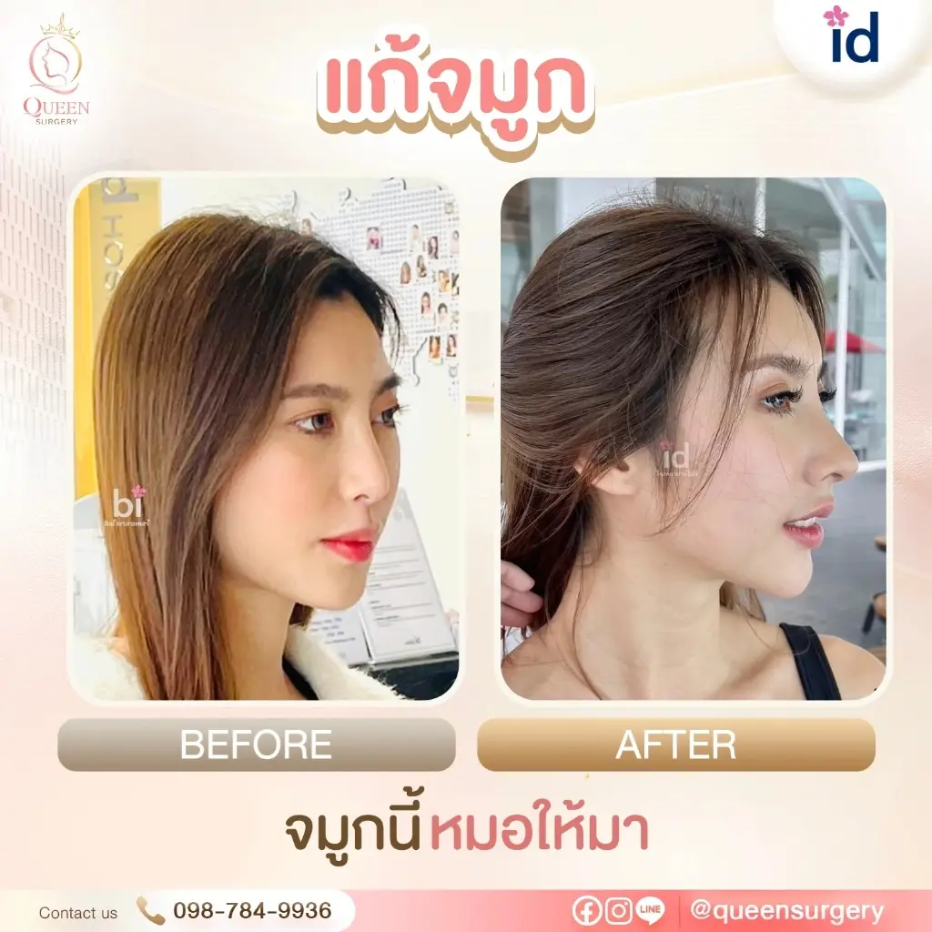 0717f3a8 afc5 442b bb3c 3483070143c4 รีวิวเสริมจมูกโด่งสโลปปลายพุ่งหยดน้ำสวยปัง NANA Plastic Surgery โดย Queen Surgery