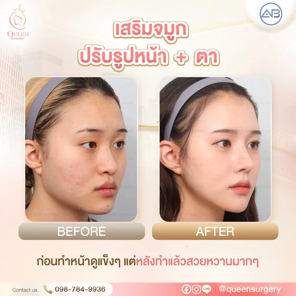 รีวิวเสริมจมูกปรับรูปหน้าและตาสองชั้นหวานฉ่ำ AB Plastic Surgery โดย Queen Surgery