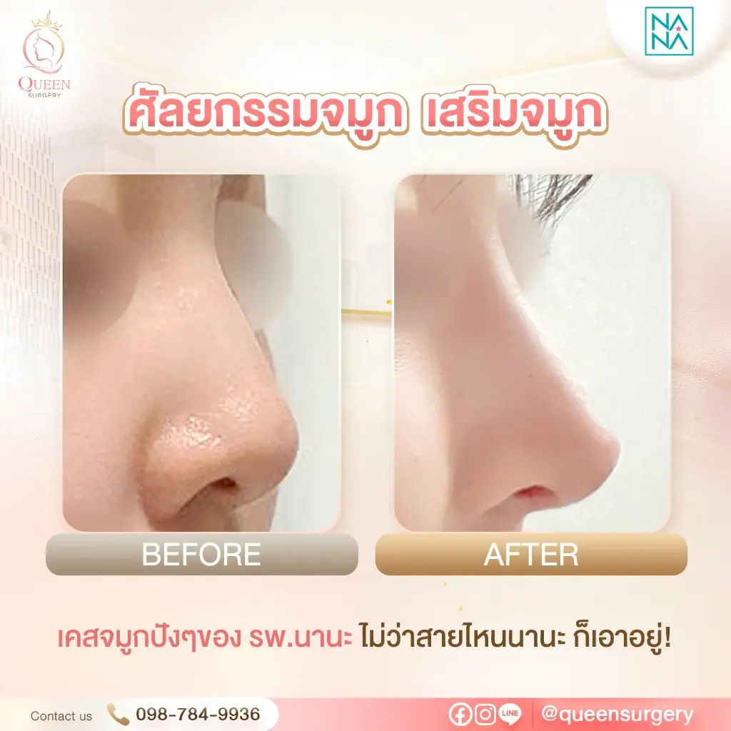 รีวิวแก้ไขจมูกฮัมพ์สูงปลายงุ้มสไตล์ S-Line ละมุน ID Hospital โดย Queen Surgery