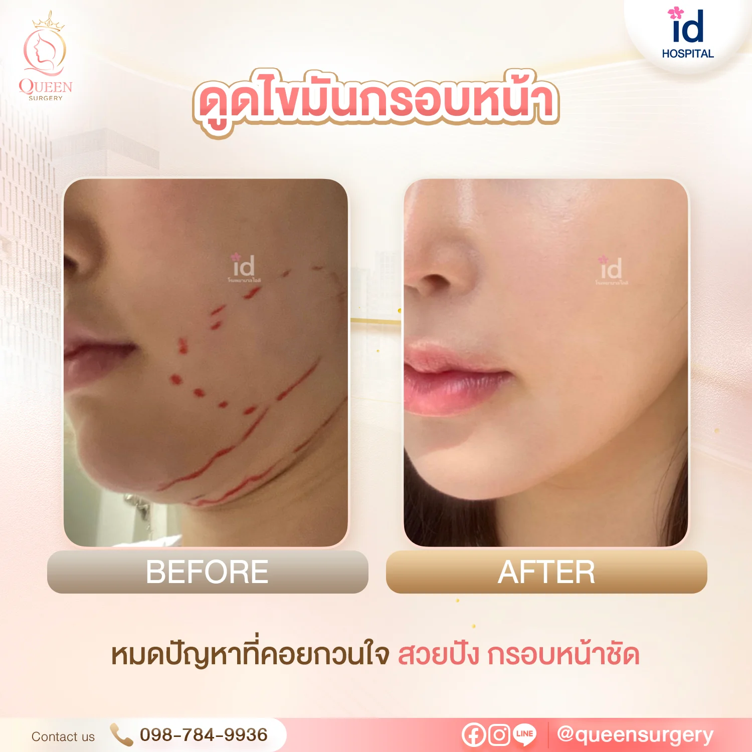 รีวิวศัลยกรรมเกาหลีจริง