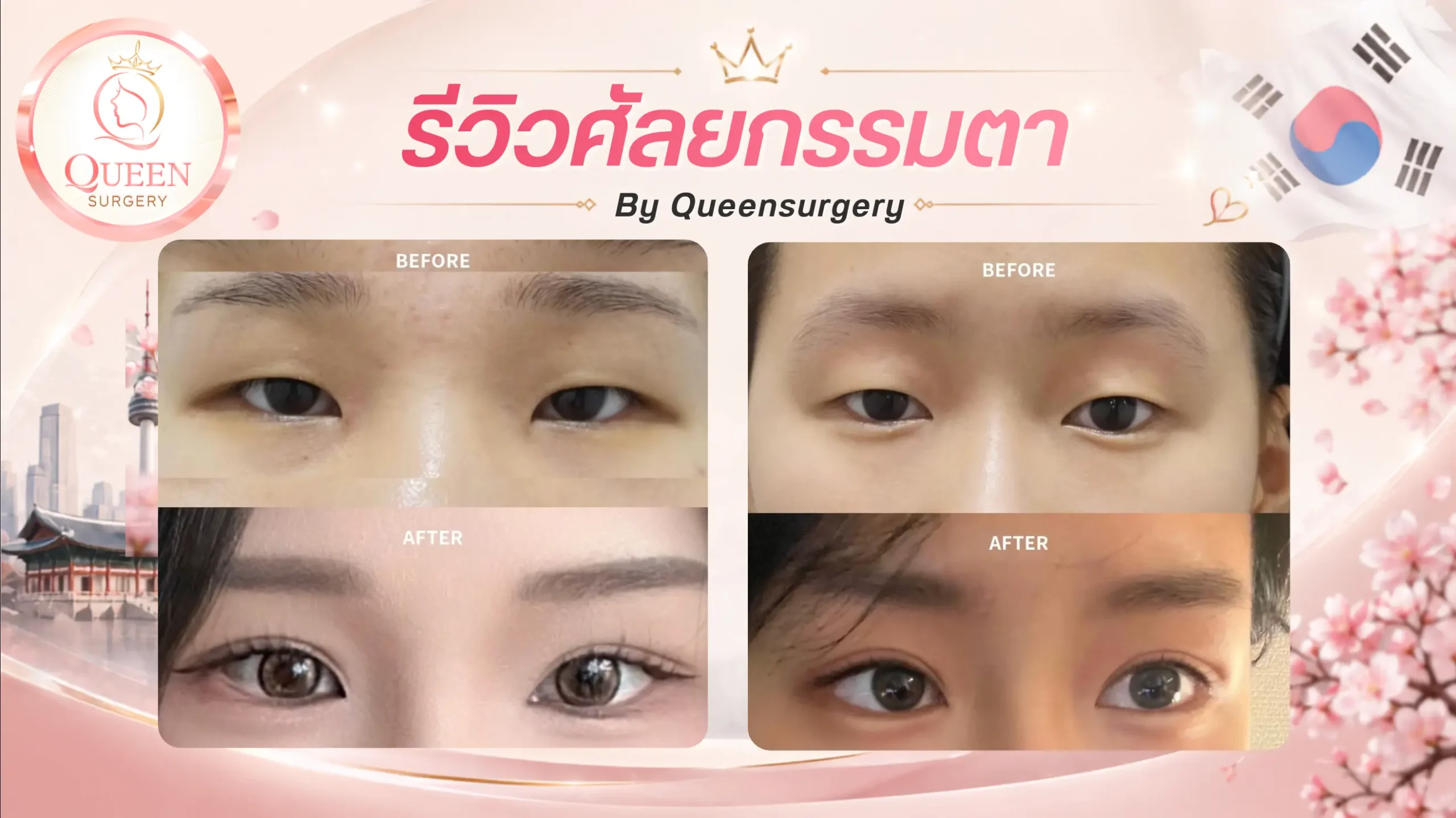 รีวิวศัลยกรรมตา