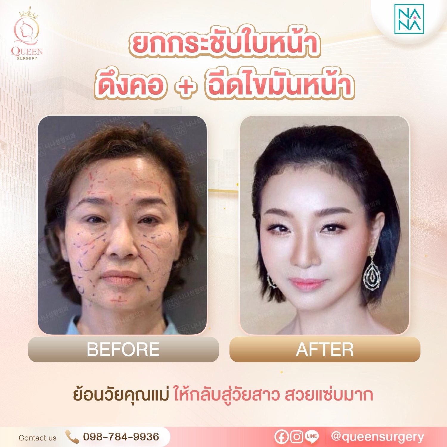 ศัลยกรรมดึงหน้า Image 49