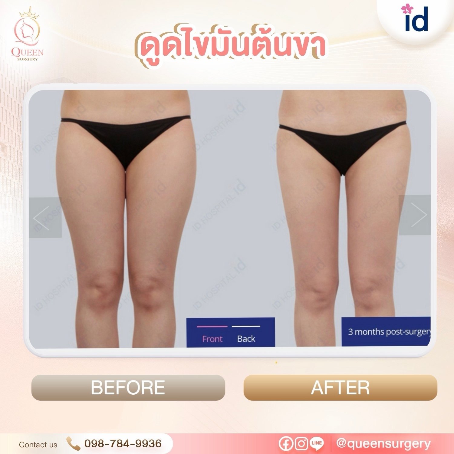 การดูดไขมัน