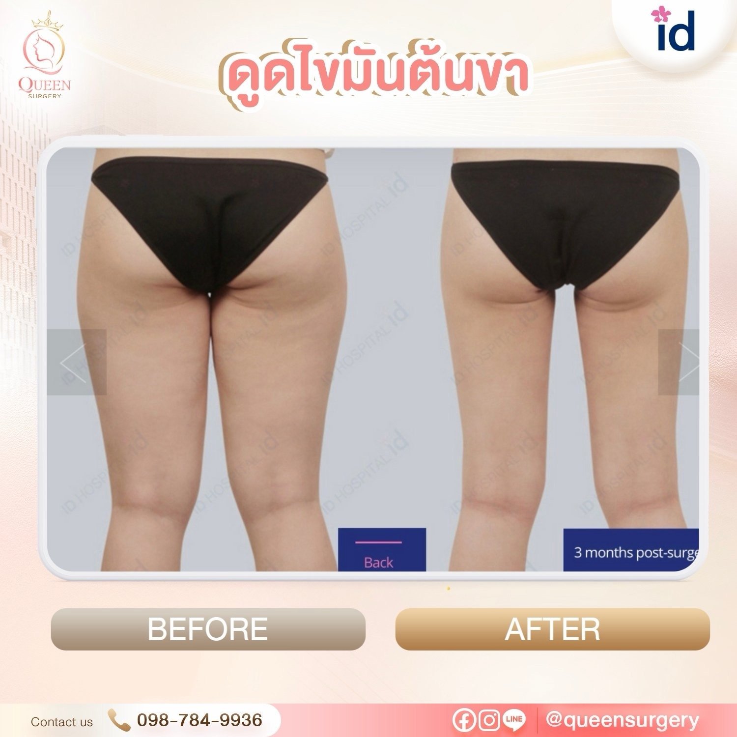 รีวิวดูดไขมันต้นขา Image 52