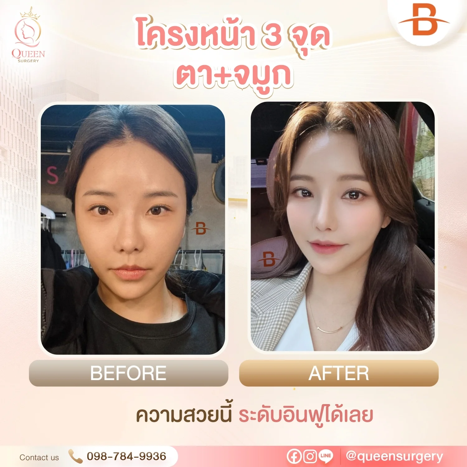 ศัลยกรรมตา