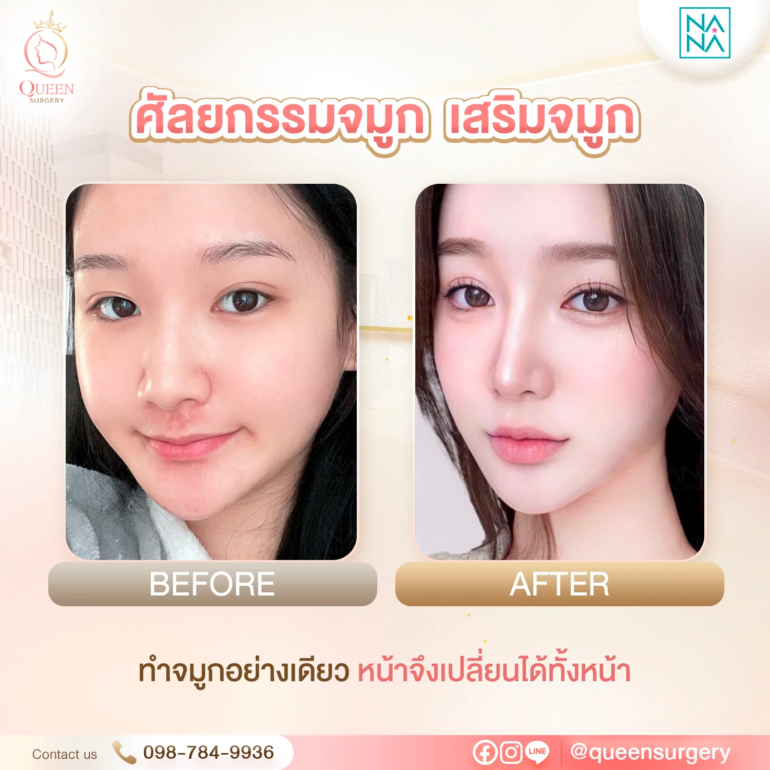 ศัลยกรรมจมูก